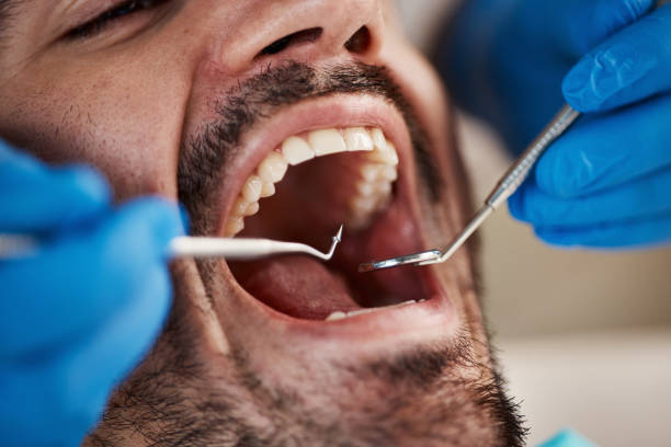Best Emergency Wisdom Tooth Extraction in Montevlo, AL